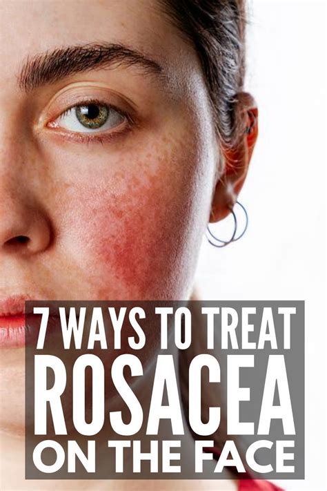 rocia|rosacea treatment symptoms pictures.